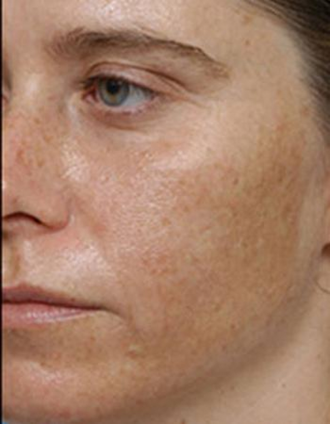 ipl-4778-before