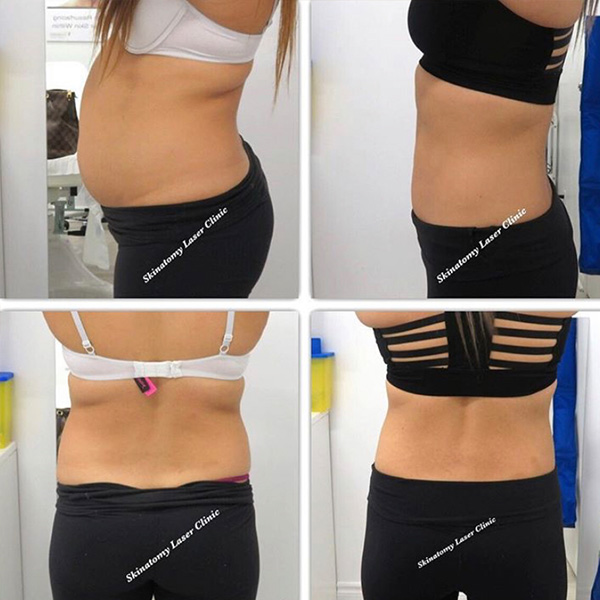 CoolSculpting-3