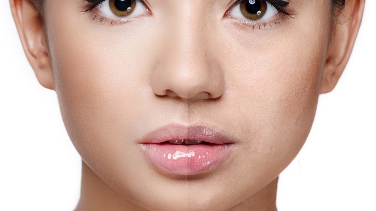 Microdermabrasion Toronto