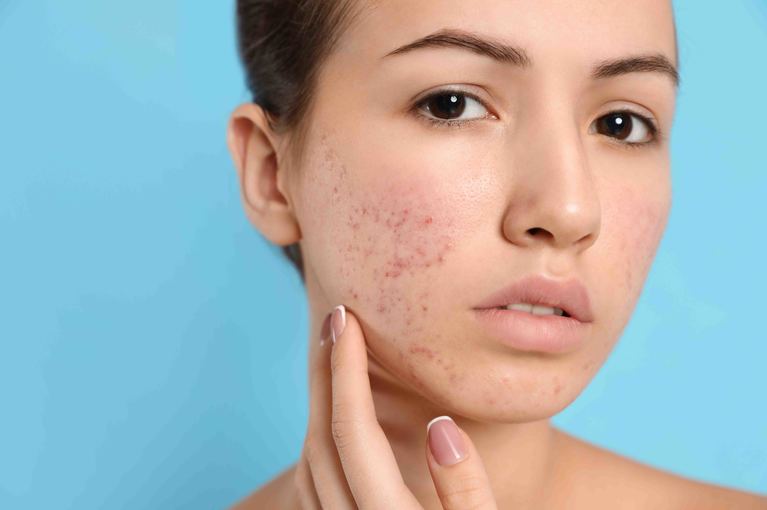 Acne Treatment Toronto